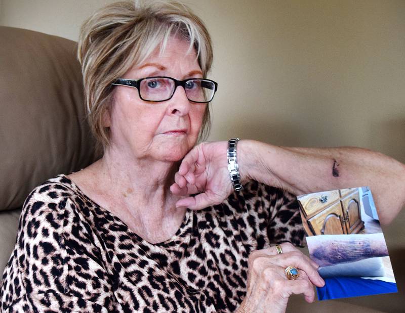 Kathy Tipton, 78, of Newton, shows a picture of her dog bite injury next to her healing arm inside her home. Kathy's husband, Max Tipton, complained to city council members about Newton's vicious dog ordinance, suggesting it needs more teeth to help victims of dog bites.